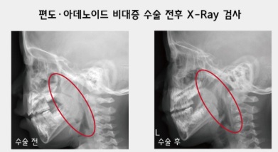 Enlarged Adenoids