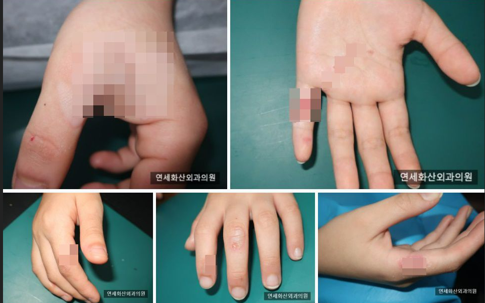 탕후루-화상문제