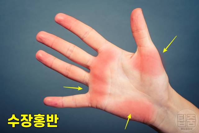 간이 안좋으면 나타나는 증상,손바닥 붉은색,간암 증상,간이안좋은증상,팁줌