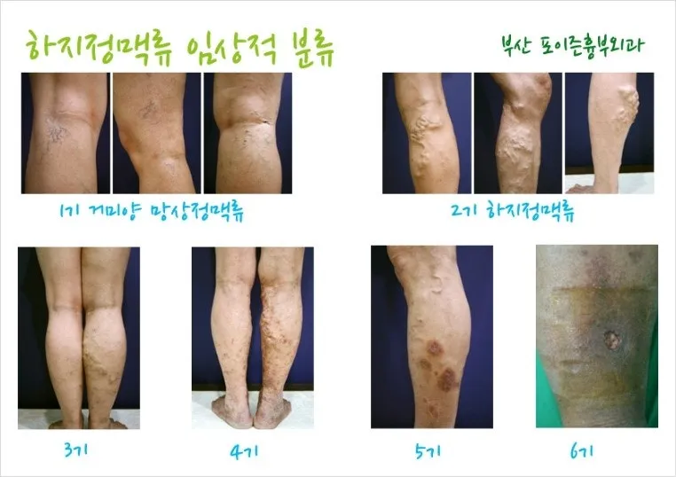 하지 정맥류 증상 치료방법과 예방 생활습관_7