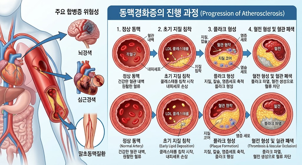 동맥경화증