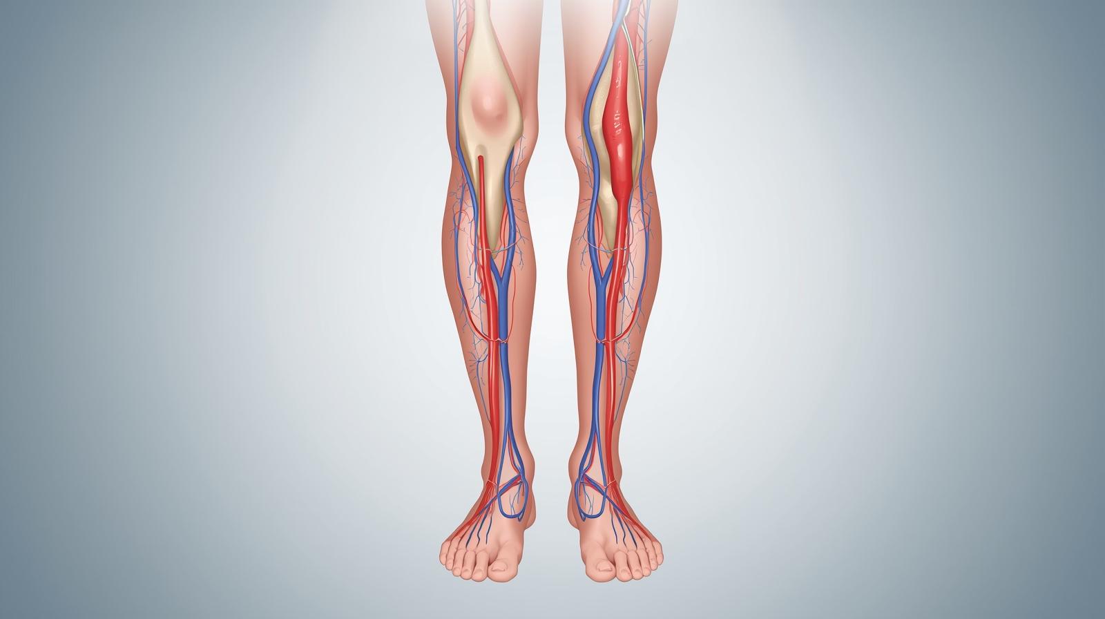 다리 혈액순환이 정체된 모습을 보여주는 인포그래픽 스타일 이미지