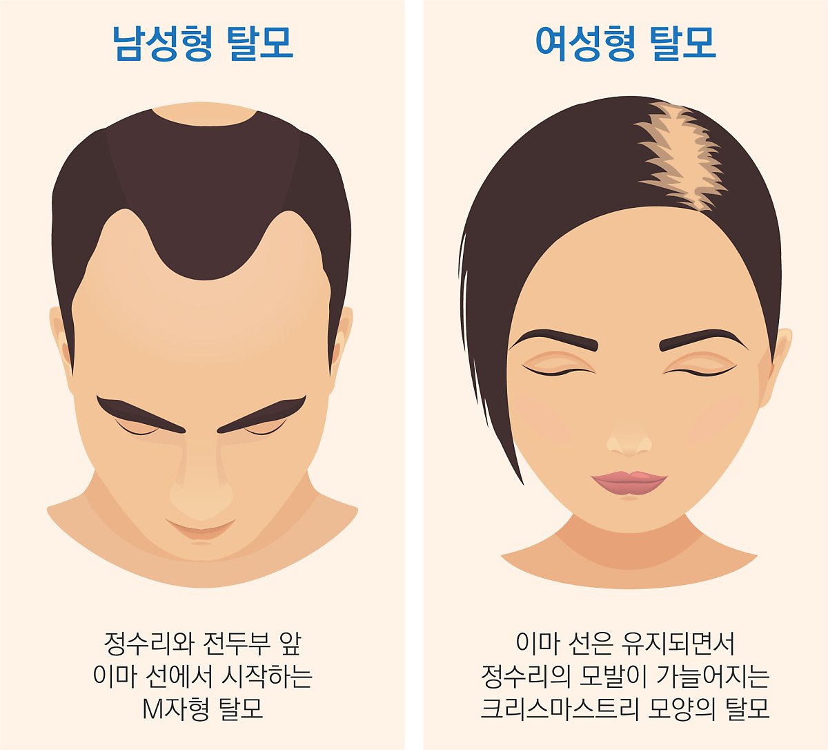 탈모 초기증상 체크리스트 (자가진단 방법)