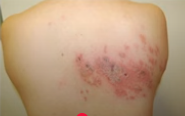 대상포진 초기 증상