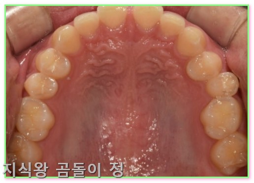 라미네이트 란? 앞니 벌어짐 해결 빠른 치료와 관리법 정리1