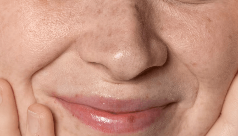 팔자주름 없애기