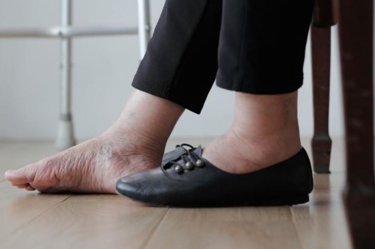 다리 붓기 빼는법 부어 있는 다리