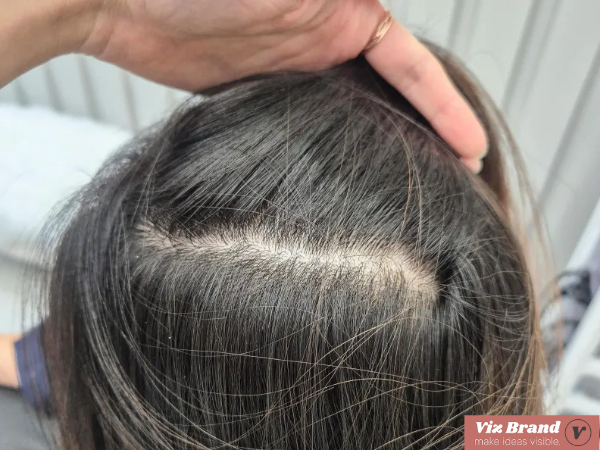 스트레스 탈모 자가진단 체크리스트