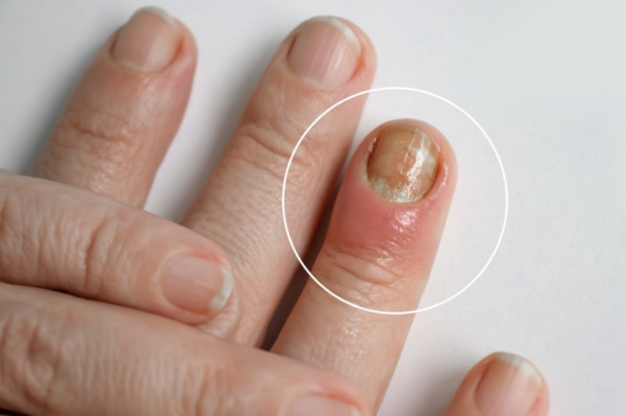 손톱 근처의 살이 벌겋게 부어오르면서, 심하면 고름이 생기는 생손앓이를 않고 있는 사람의 손가락을 확대를 하여 찍은 사진