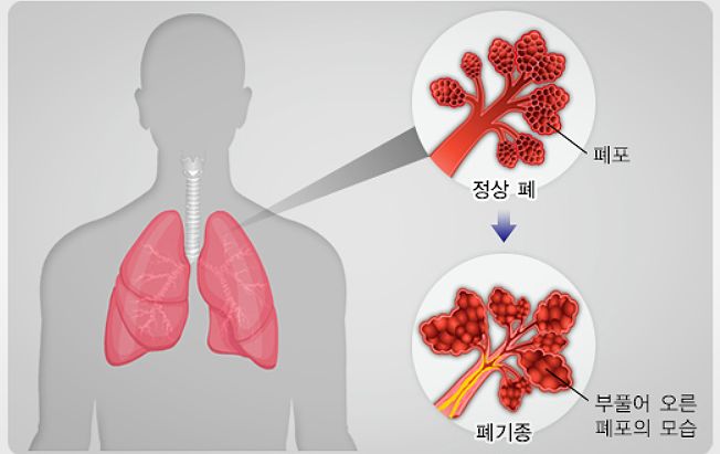 호흡기 질환: 폐기종-원인, 증상, 치료방법, 진행단계, 진행속도 조절방법.