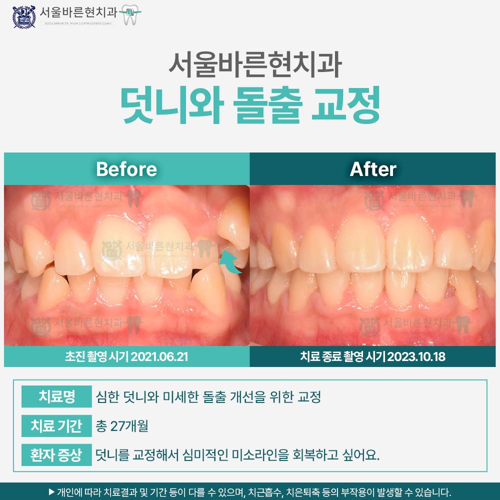 해운대돌출입교정