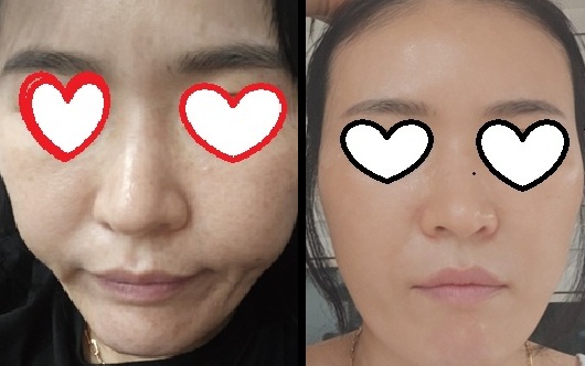 제네오엑스 전후 피부 변화 모공 피부톤 개선 후기