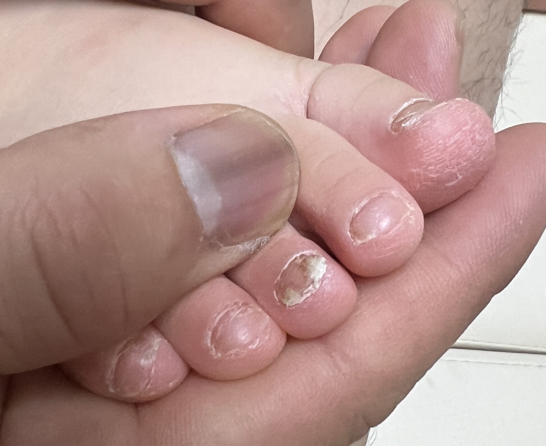 아이 발톱무좀 사진