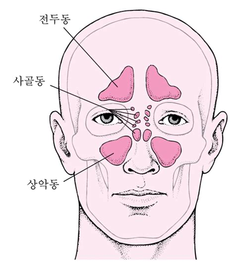 (부비동암)