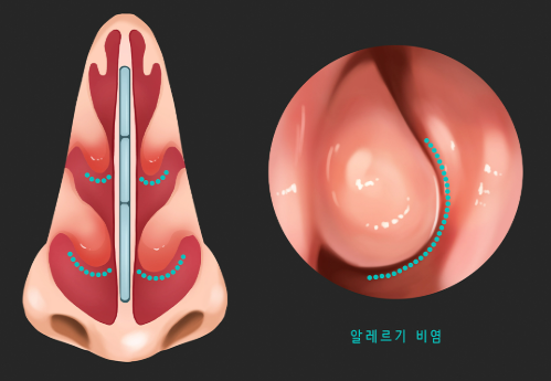 알레르기 비염
