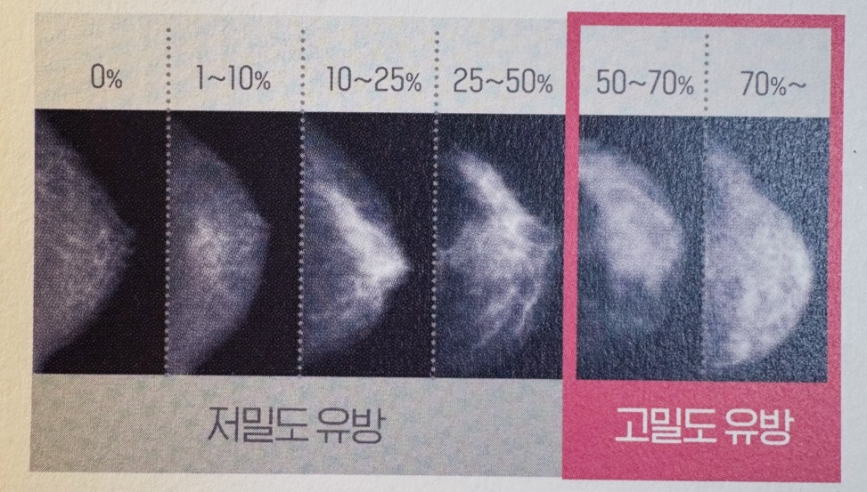 유방 치밀도 