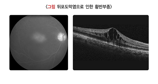 포도막염