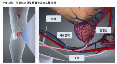 전립선암이미지