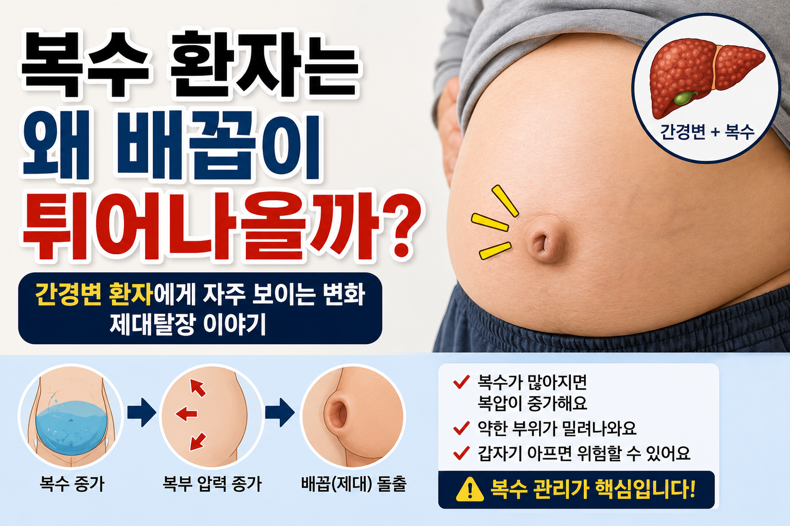 복수 환자에서 복부 압력 증가로 배꼽이 튀어나오고 제대탈장이 생길 수 있는 과정을 설명하는 의료 건강정보 썸네일 이미지