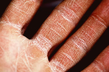 피부질환 종류 연고 종류 이유