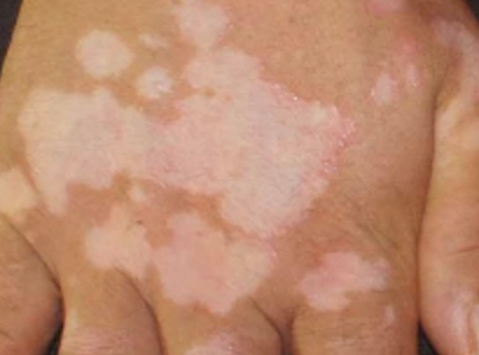 피부 곳곳에 갑작스럽게 흰 반점