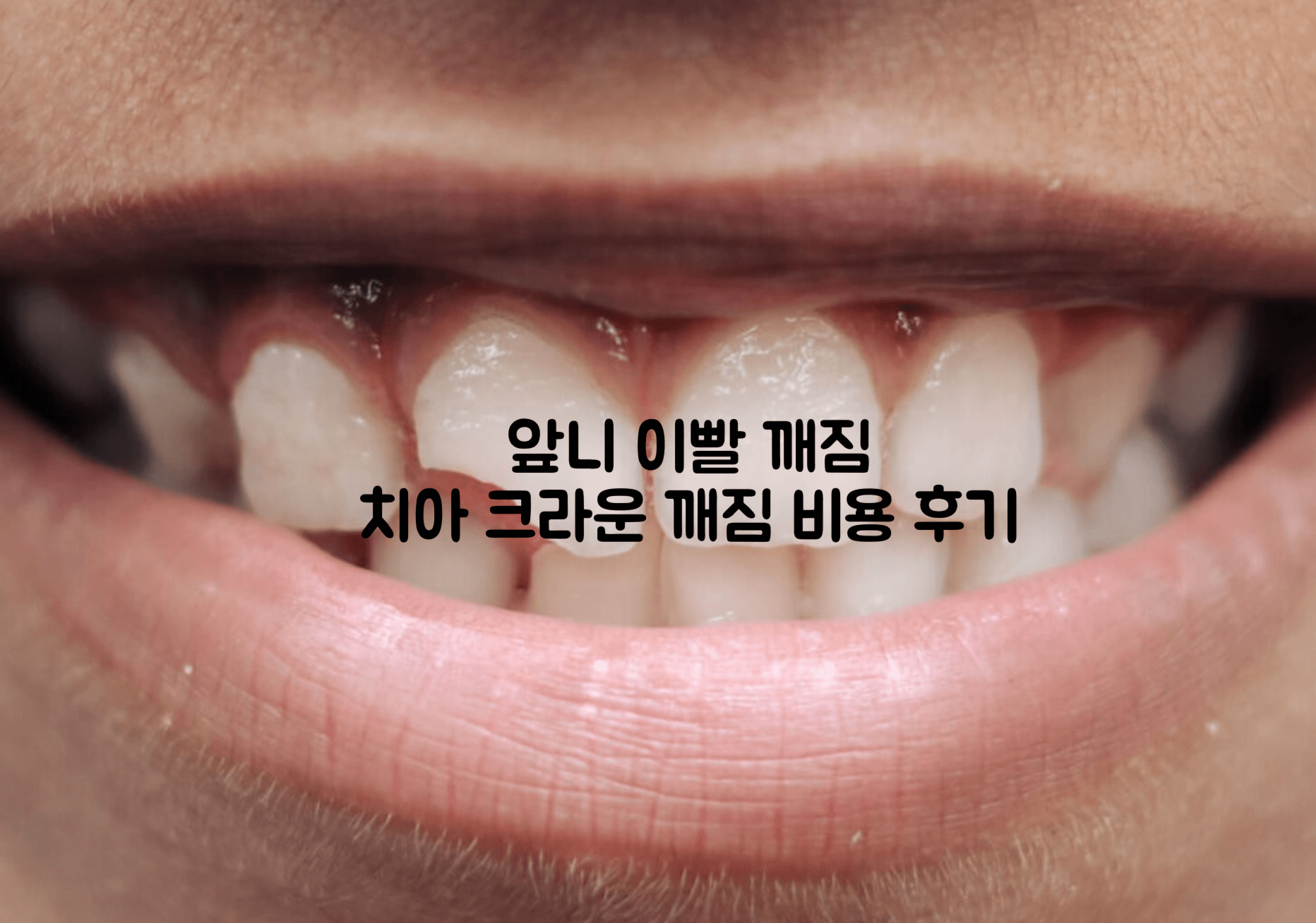 앞니 이빨 깨짐