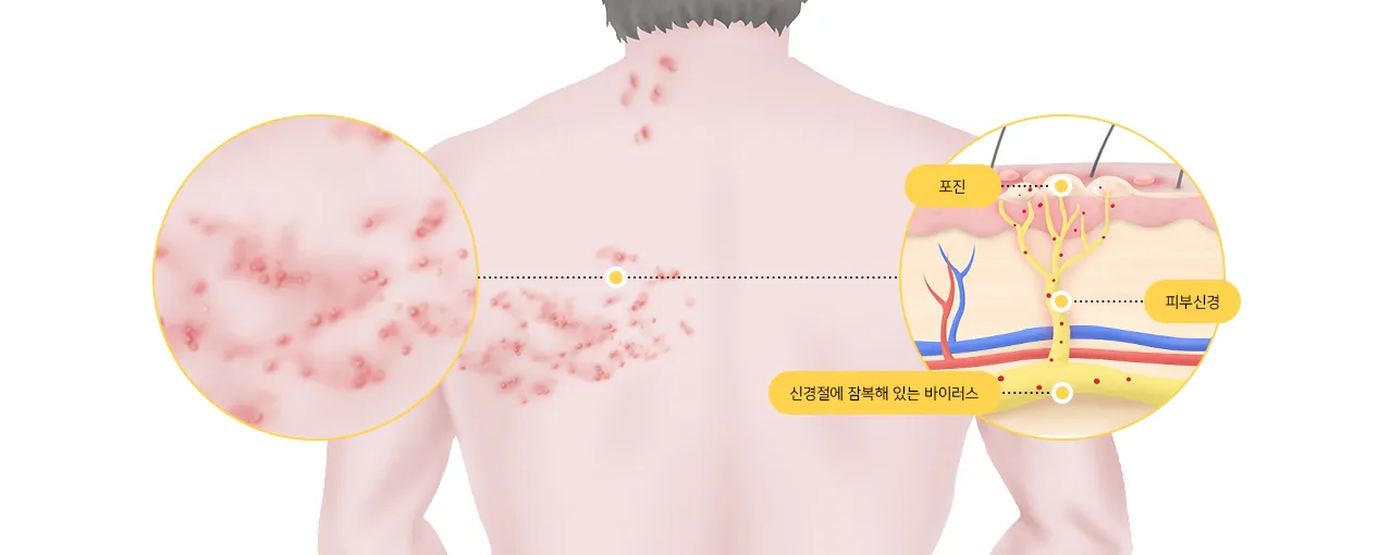 대상포진 병원어떤과로가나요
