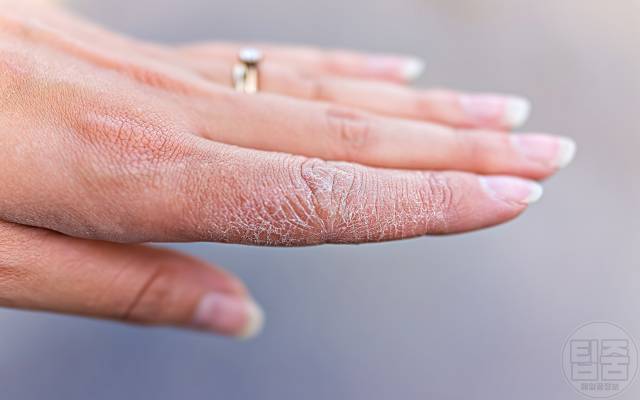 거칠어진 손 관리법 손이거칠어요 손가락 끝 갈라짐 손보들보들