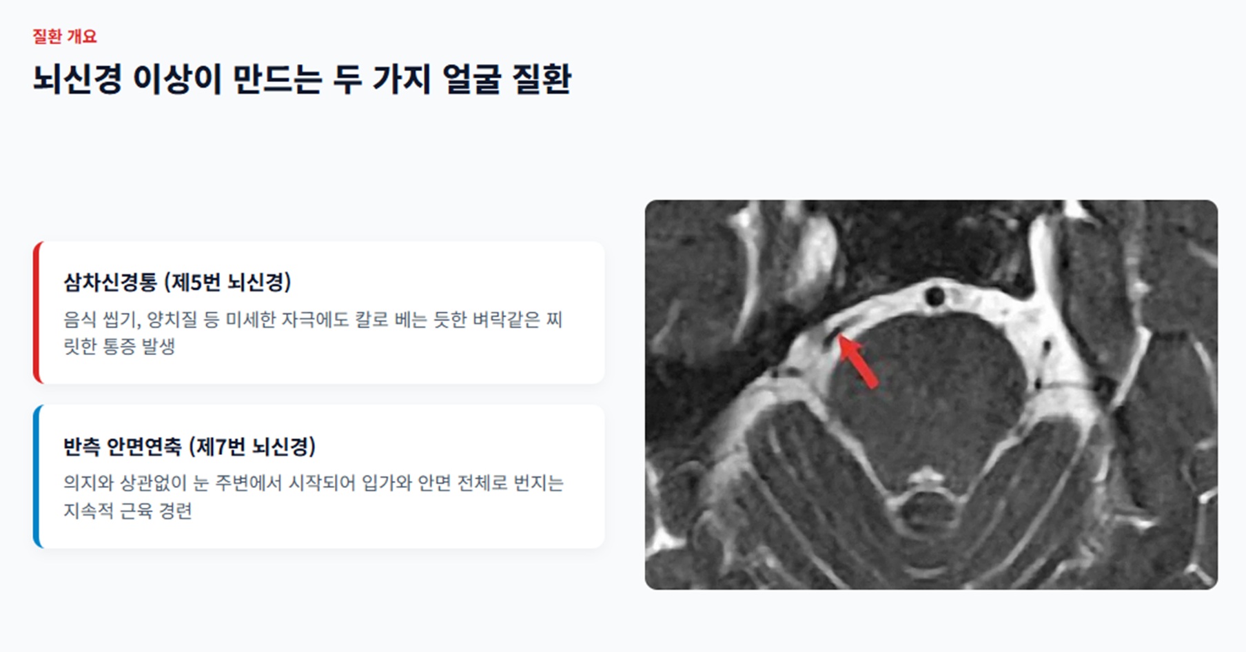 삼차신경통-안면연축-정현호교수