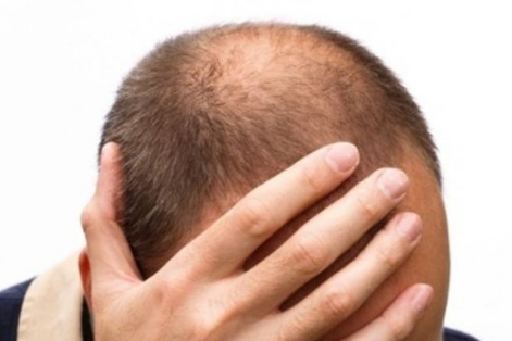 탈모로고민인남성