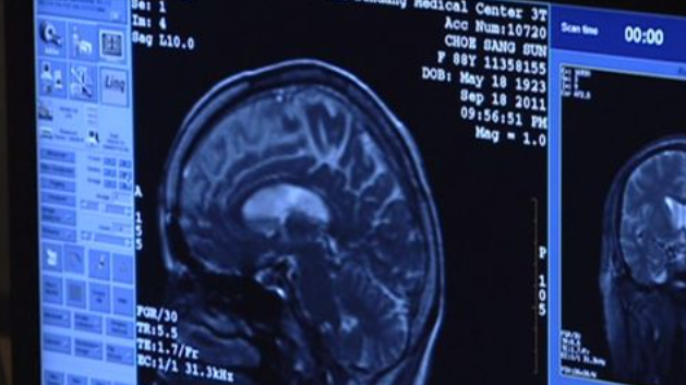 섬망 증상에 좋은 영양제