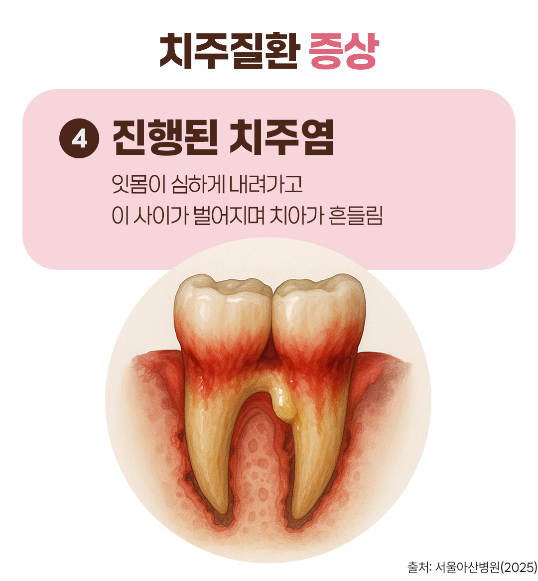 #치주질환 증상 #진행된 치주염 #잇몸이 심하게 내려가고 이 사이가 벌어지며 치아가 흔들림