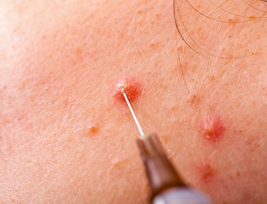 여드름 염증 주사 (트리암시놀론, 덱사메타손) &ndash; 효과 및 주의사항