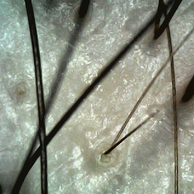 탈모 극복 프로젝트 - 정수리와 이마 사이 두피모습이다.