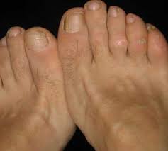 티눈이 생기는 이유