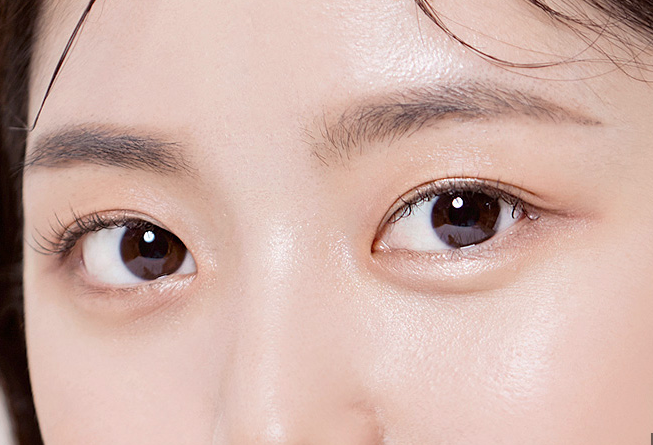 쌍꺼풀수술 쌍꺼풀붓기 쌍꺼풀회복 쌍수후기 눈수술 성형수술 붓기관리 쌍꺼풀관리 눈성형 성형후관리