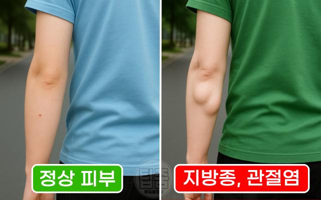 팔꿈치 혹 지방종