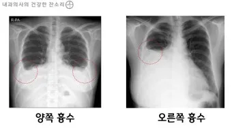 폐에 물이 차는 원인 증상 물참 관리 포인트에 대한 건강정보_2