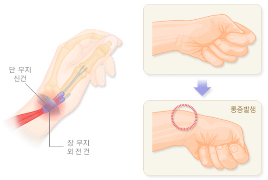 손목에 빨간색 블러처리된 일러스트