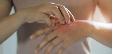 대상포진 증상 수포 사진