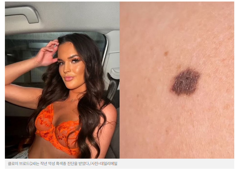 피부암 초기증상