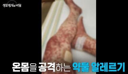 약물알레르기