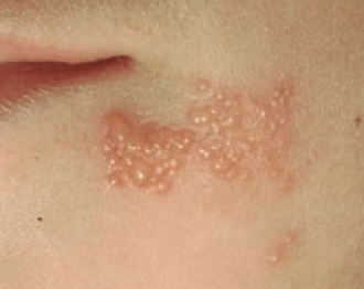 입술물집(헤르페스 1형)