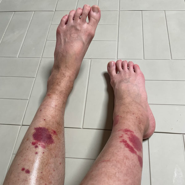 혈관염 증상 - 덩어리 출혈이 군데군데 발생함