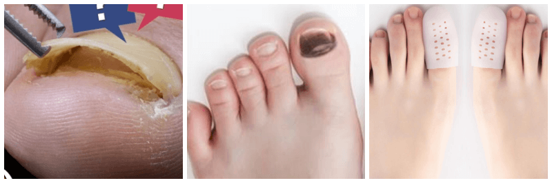 들린 발톱, 빠진 발톱, 발톱 보호대 사진