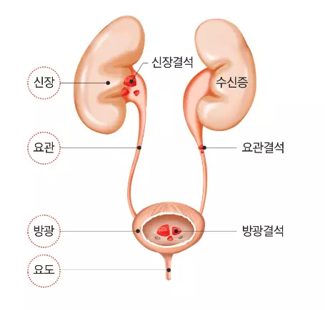 요로결석