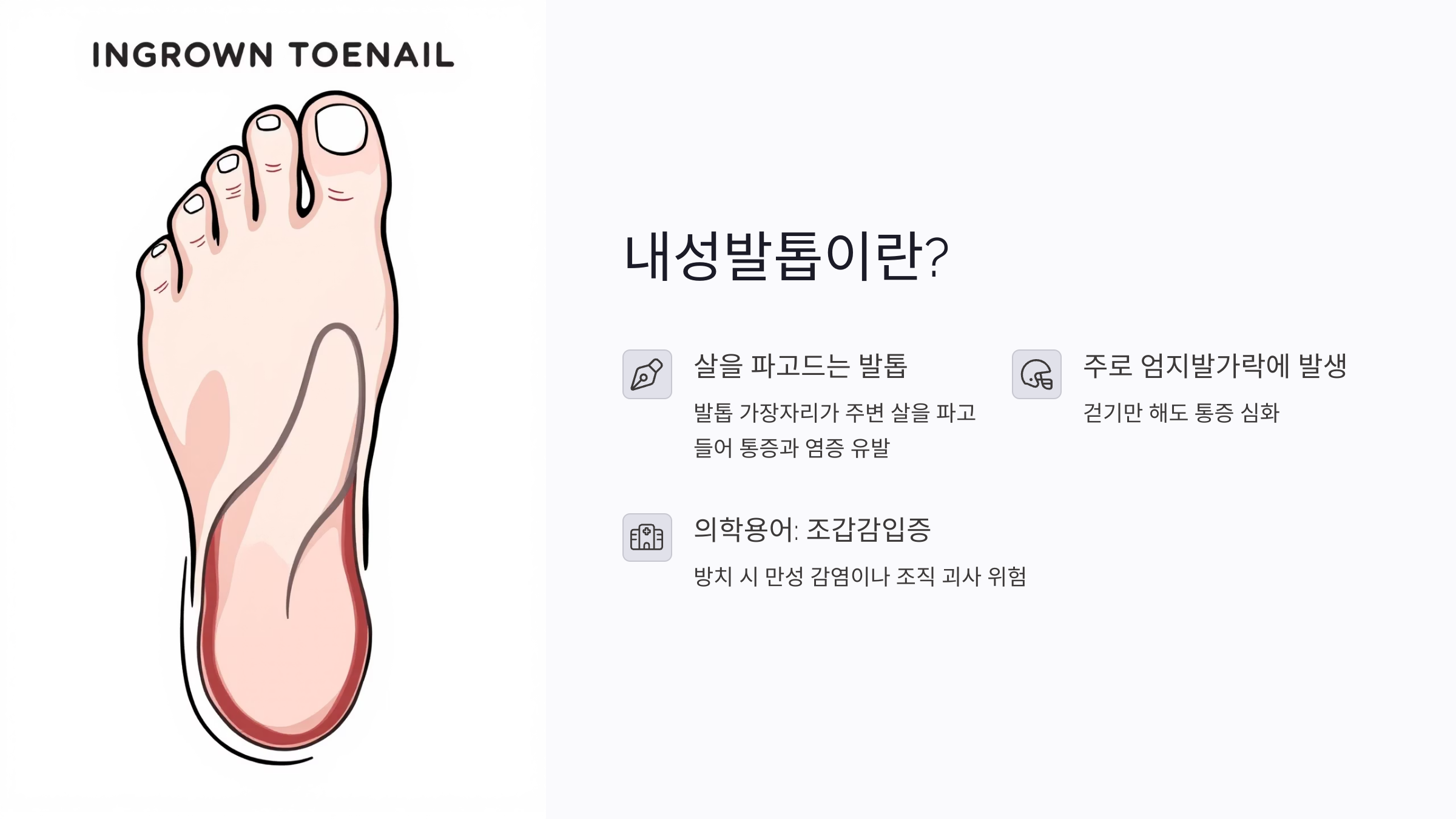 내성발톱이란 무엇인가요?