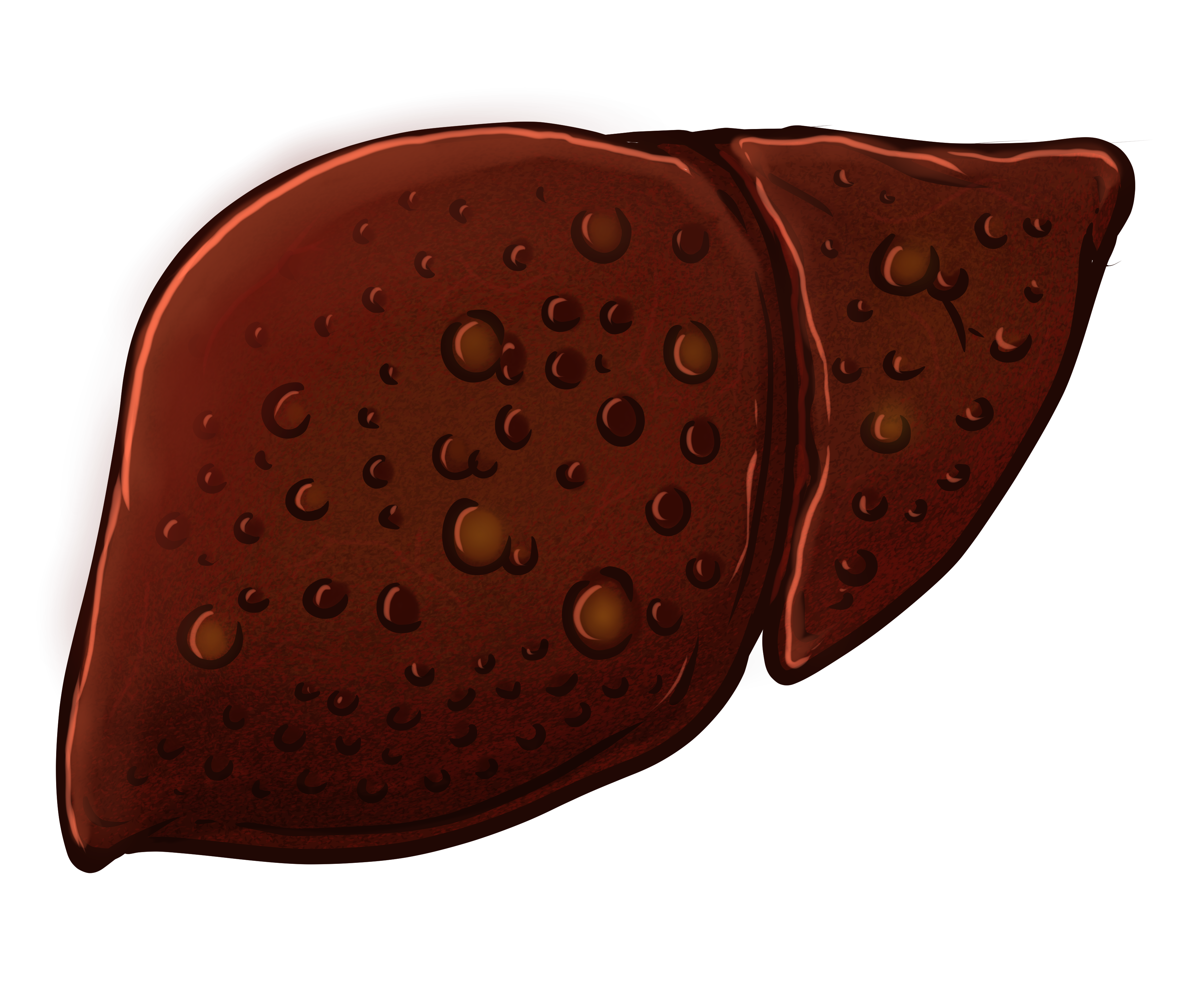 간경변증 원인 초기증상 효과적인 약물치료 식이요법 말기증상 대처법
