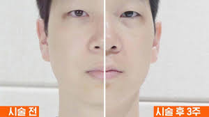 슈링크 리프팅