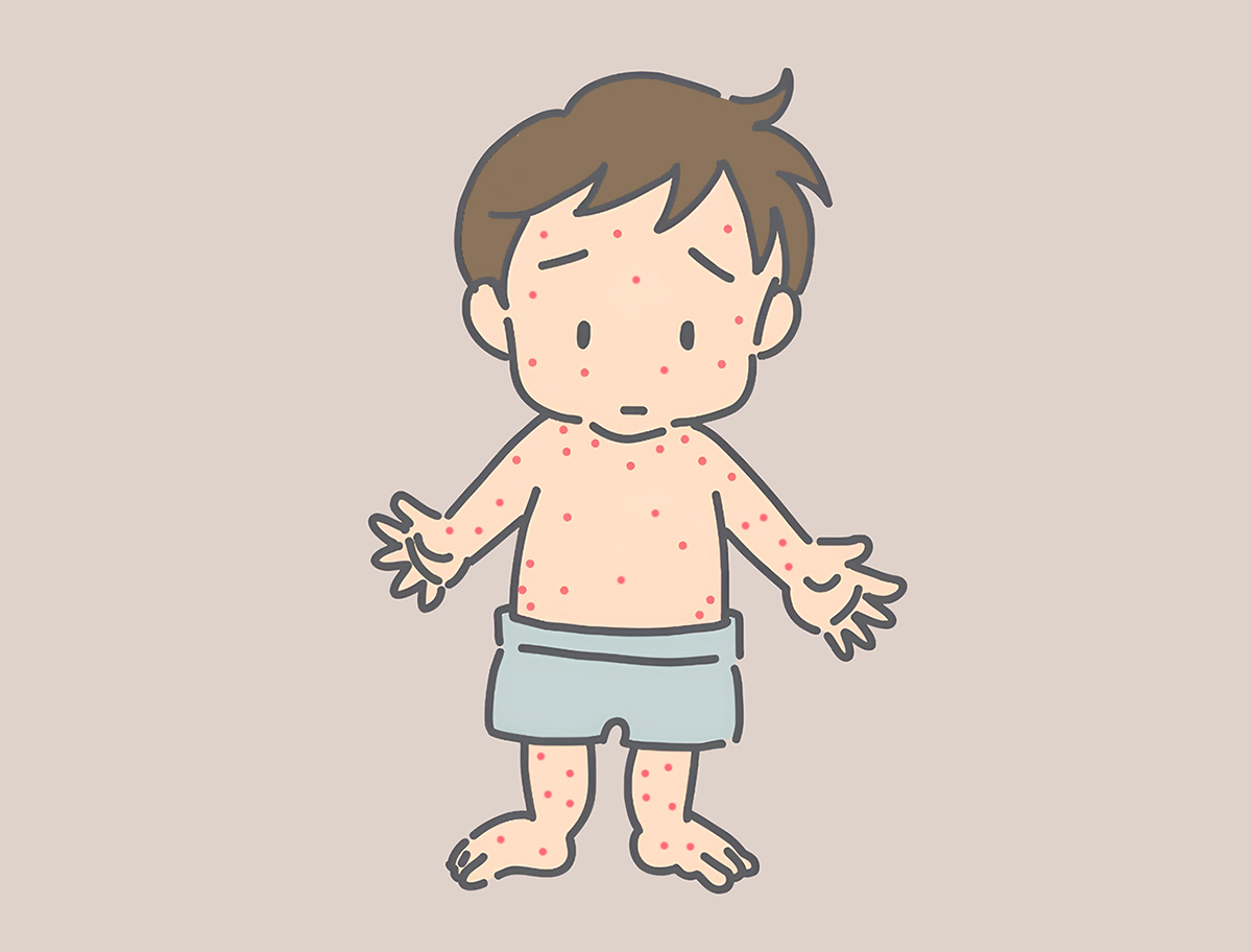 홍역에-걸린-아이